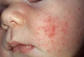 infant acne