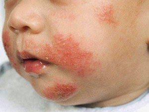 Baby Rash Decoder: What is This?