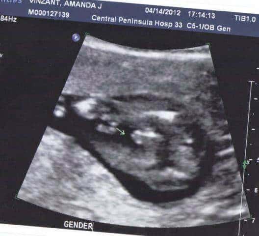 Ultrasound detect gender when can How to