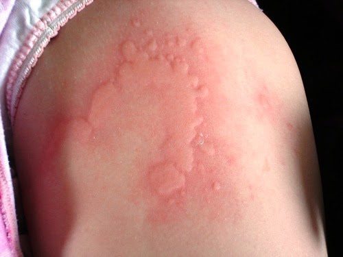 baby rash hives