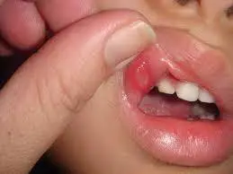 toddler with mouth sores food list