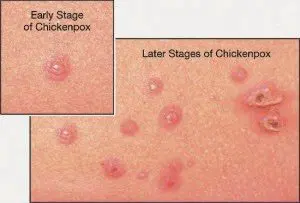 chicken pox
