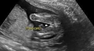 gender ultrasound accuracy