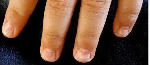 Peeling Nails Nails Falling Off shedding nails Onychomadesis hand foot and mouth