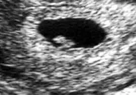 6 weeks pregnant ultrasound