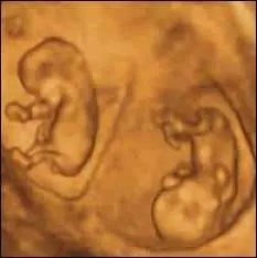 8 weeks pregnant ultrasound twins