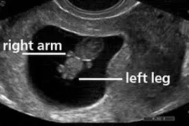 Ultrasound at 8 weeks pregnant