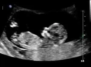 9 weeks pregnant ultrasound