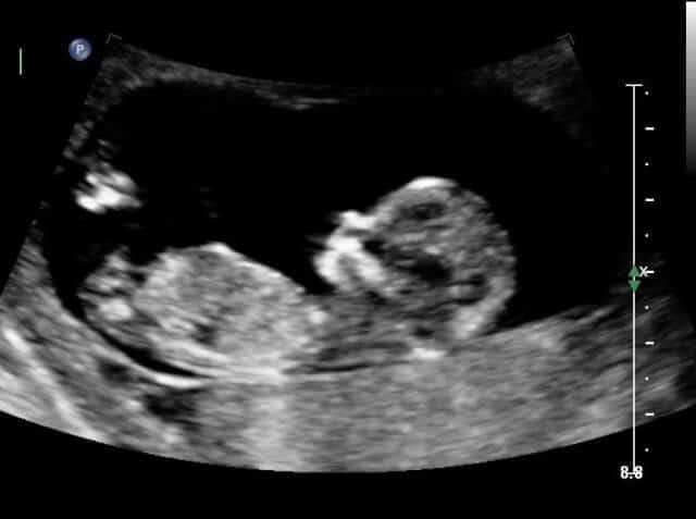9 what to week ultrasound expect at 16 Weeks
