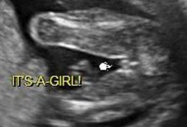 can ultrasound be wrong about gender